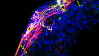 A regenerated auditory nerve in cat  after neurotrophin gene therapy 