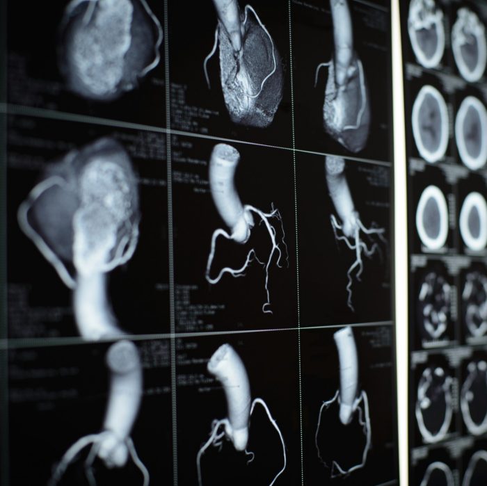 CT images on black film of human heart and coronary artery