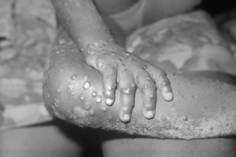 Close-up of monkeypox lesions on the arm and leg of a female child.