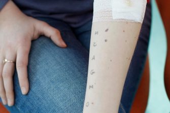 Photo of woman undergoing skin prick allergy testing